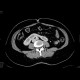 Ren arcuatus, horseshoe kidney: CT - Computed tomography